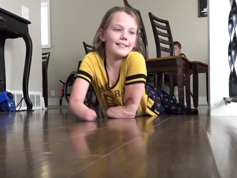 Miracle after car accident losing her limbs